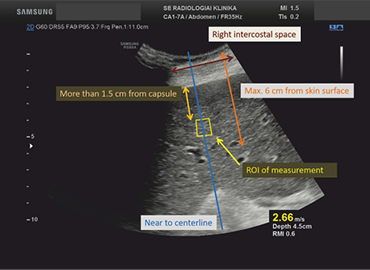 S-Detect™ for Breast